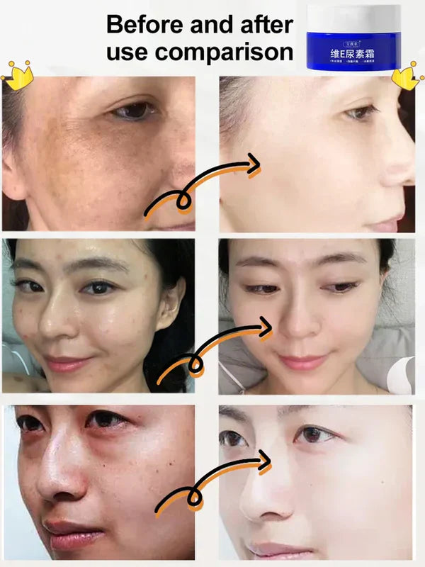 SPOT FADED UREA CREAM